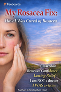 My Rosacea Fix: How I was Cured of Rosacea